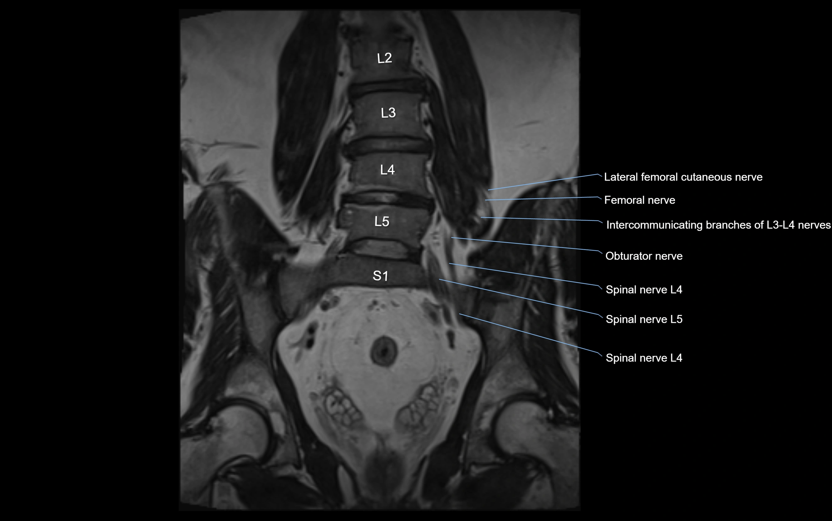 MR lumbosacral plexus cross sectional anatomy 3T  radiology  image-img-09001-00033.webp